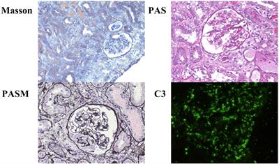 Case report of renal manifestations in X-linked agammaglobulinemia